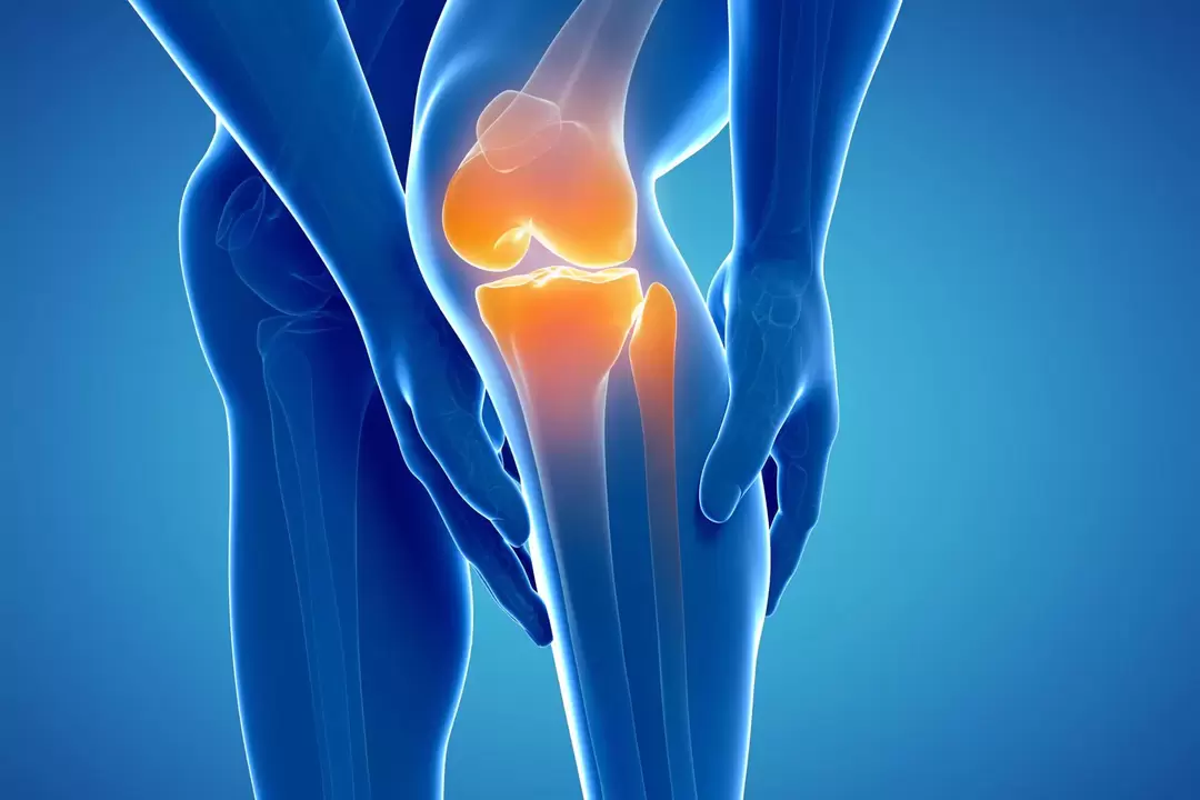 Knee joint arthrosis (gonarthrosis, deforming osteoarthritis)