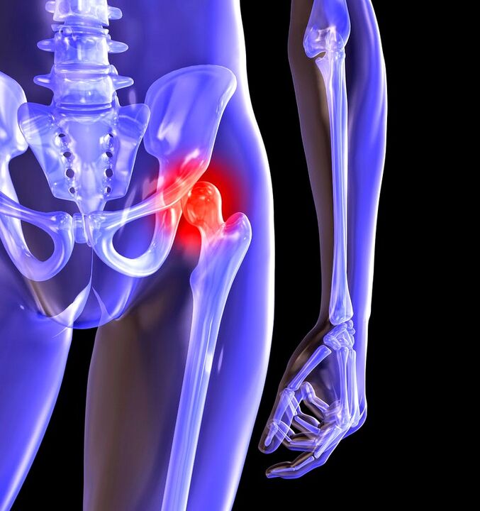 Deformation of the arthrosis of the hip joint