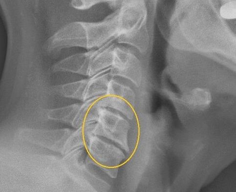 Osteochondrosis of the cervical spine in an X -ray