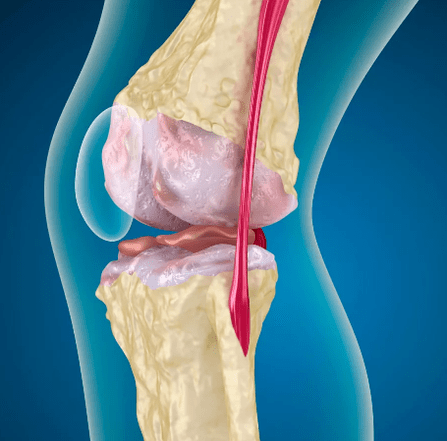 Arthrososis of the knee joint
