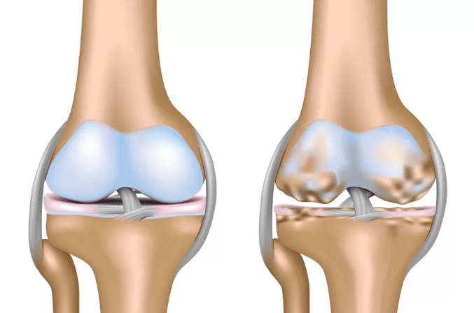 Deformation of the arthrosis of the knee joint