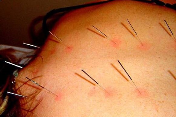 Acupuncture - a method for the treatment of cervical osteochondrosis