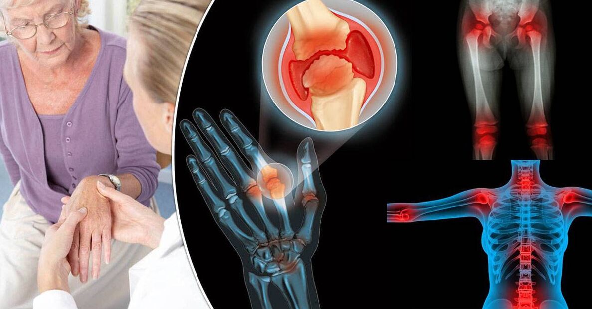 what is arthrosis